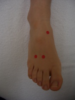 足の甲の痛み
