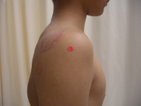 インピンジメント症候群