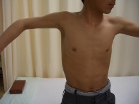 インピンジメント症候群２